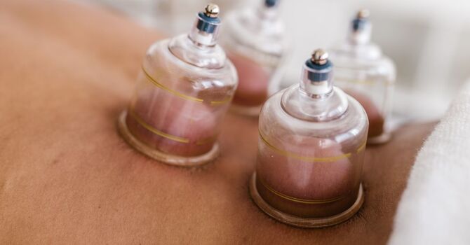 What Are the Benefits of Cupping image